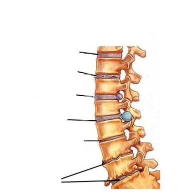 Entwicklungsstadien der Osteochondrose