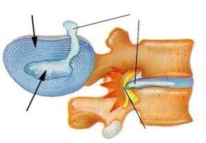 Zerstörung des faserigen Rings mit zervikaler Osteochondrose