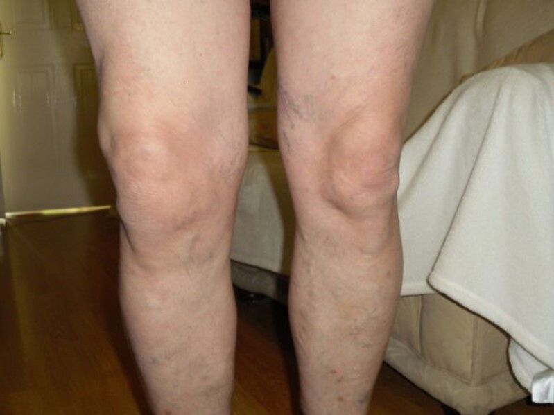 gesundes Knie und Arthrose des Kniegelenks